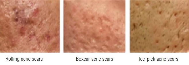 rolling acne scars