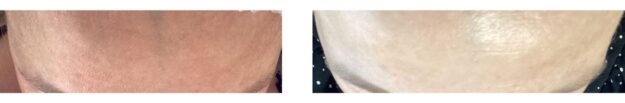 MKSkin-TCAChemicalPeelTreatment1 MKSkin-TCAChemicalPeelTreatment1