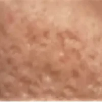BoxScar-Acne_Mkskin