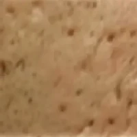 Ice-pick_Acne_Scars_MKSKIN
