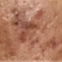RollingAcneScars_MKSkin